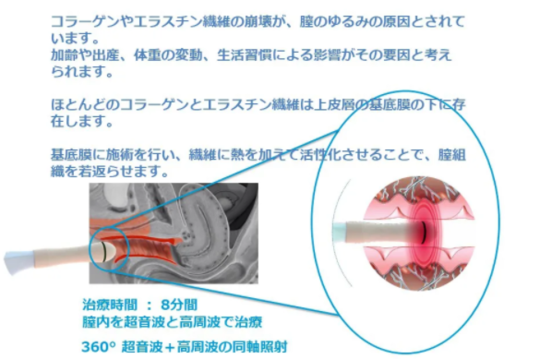 膣タイトニング - まりこ泌尿器・漢方内科（愛知県 江南市の泌尿器科・女性泌尿器科・漢方内科）